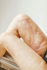 skin burn
